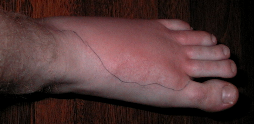 التهاب النسيج الخلوي